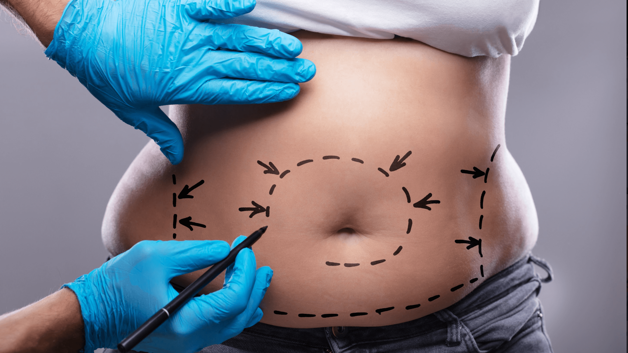 How to Prepare in Advance for Tummy Tuck Surgery